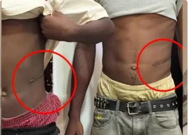Lawyer Alleges Illegal Organ Harvest in Abuja, Claims Kidneys Sold for N1.5m